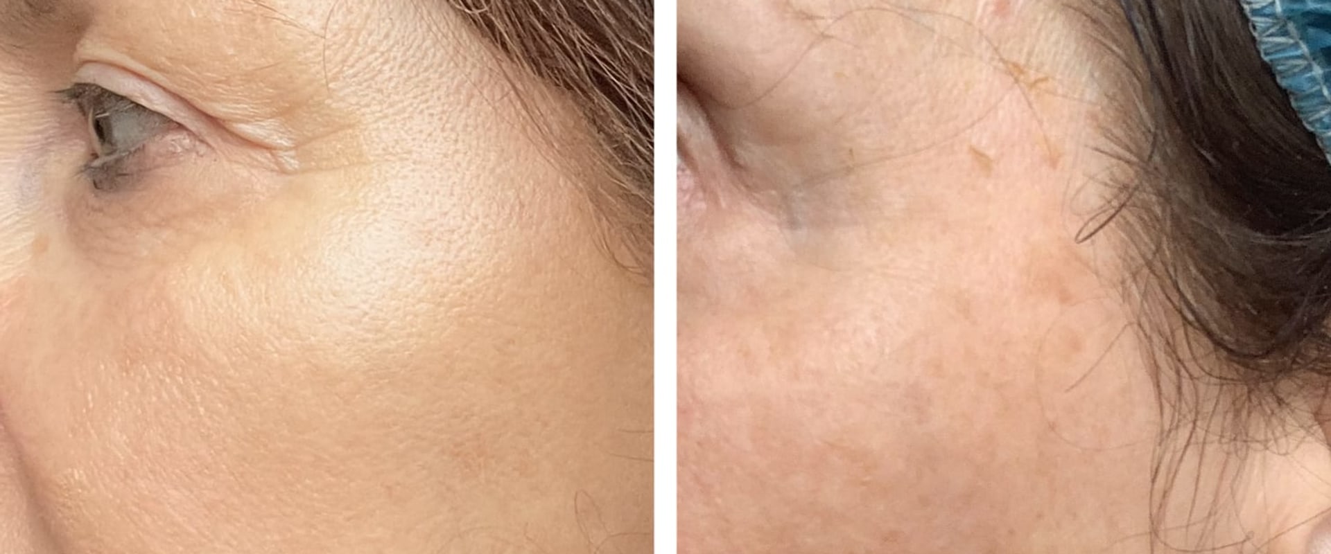 Understanding Cosmelan Depigmentation Treatment for a Flawless Complexion