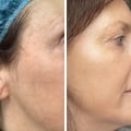 Understanding Cosmelan Depigmentation Treatment for a Flawless Complexion