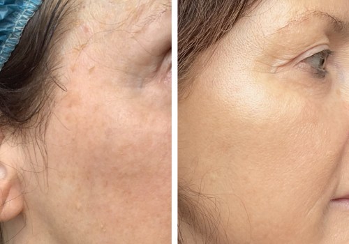 Understanding Cosmelan Depigmentation Treatment for a Flawless Complexion